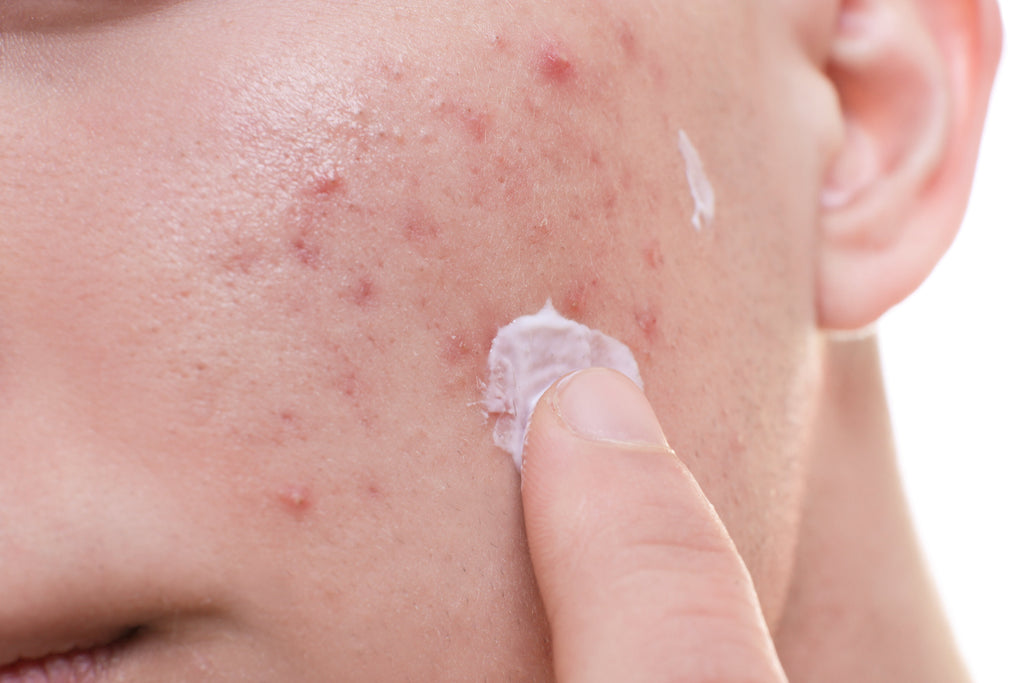 Retinol ile Akne Tedavisi