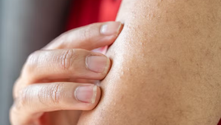 Keratozis Pilaris (Tavuk Derisi Görünümü) İçin En İyi Bakım Önerileri