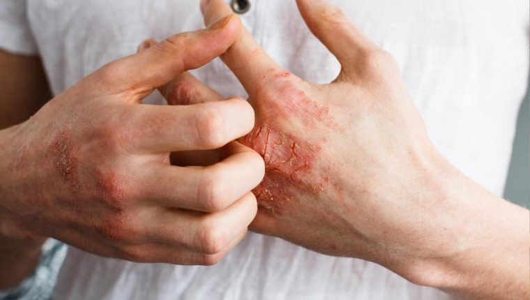 Egzama ve Rosacea İçin Cilt Bakımında Nelere Dikkat Edilmeli?